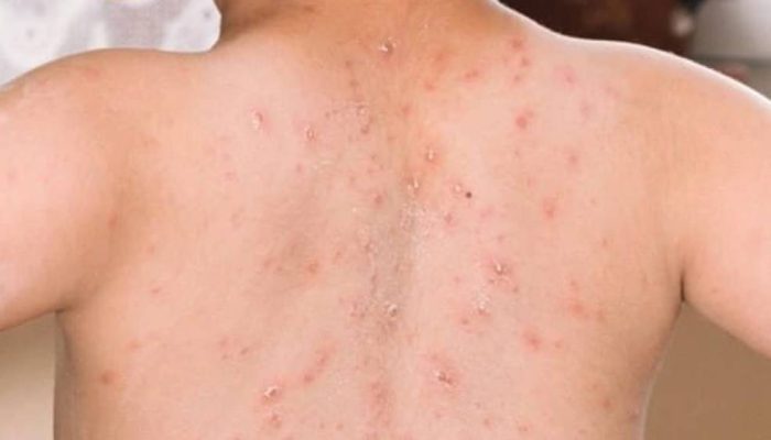 Sumenep Berstatus KLB Campak, 17 Orang Meninggal Dunia